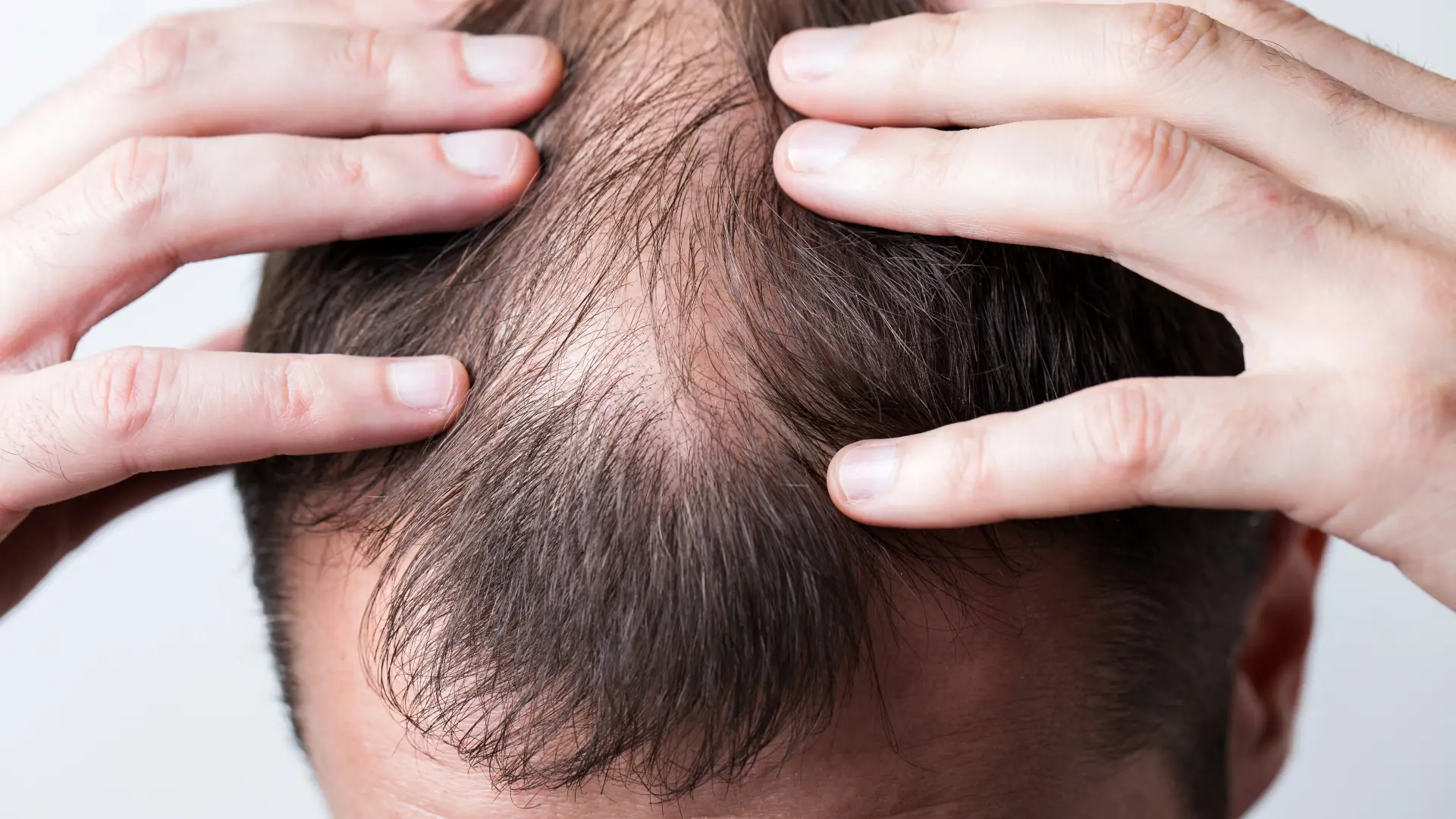 Am I Balding? How to Identify Hair Loss Early